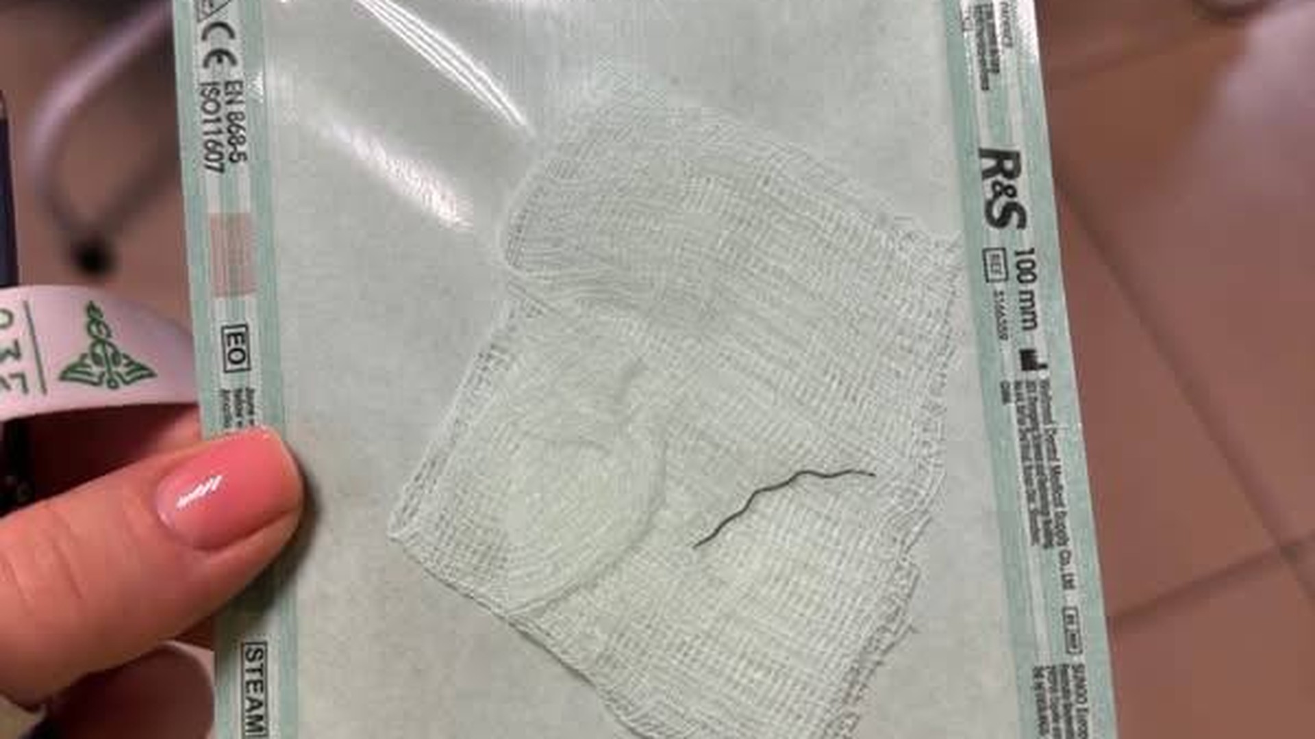 Хірурги у Львові видаляють 2-сантиметровий дріт від болгарки з ока 17-річного Михайла та рятують йому зір